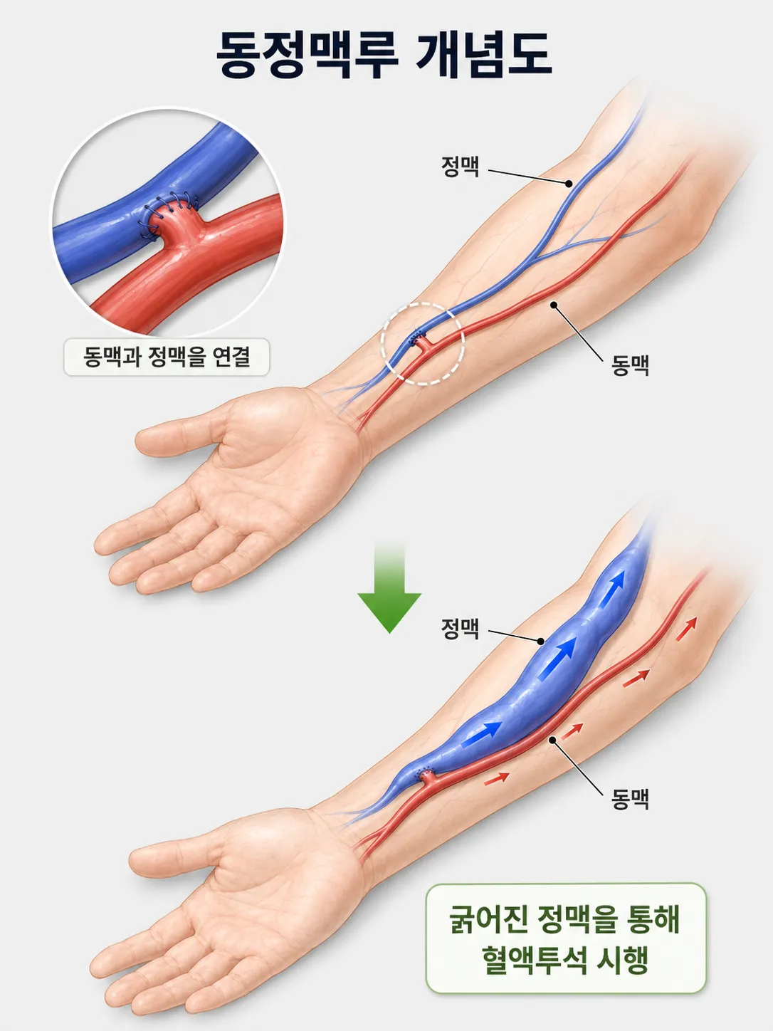동정맥루 조성술 동맥 정맥 연결 개념도