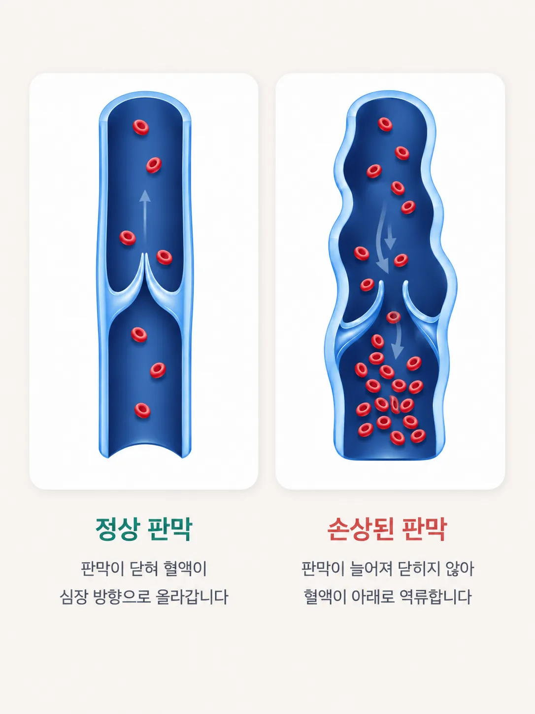 부산 비만클리닉 - 정상 정맥 판막과 손상된 판막의 역류 비교