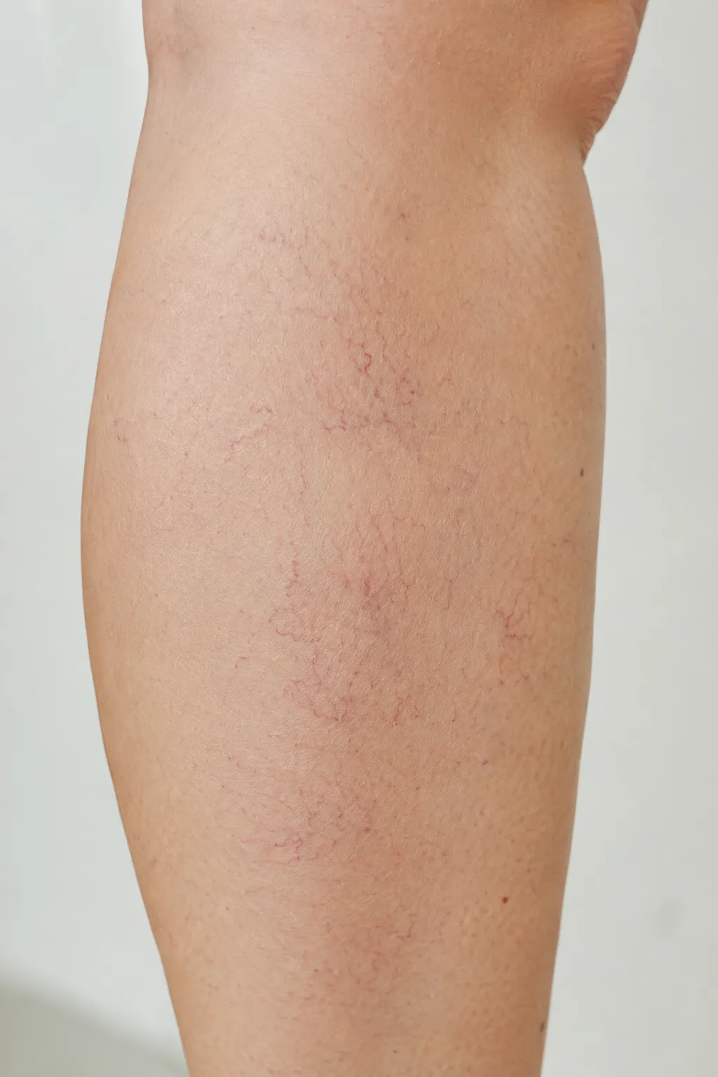 하지정맥류 거미양 정맥류 실핏줄 종아리 클로즈업