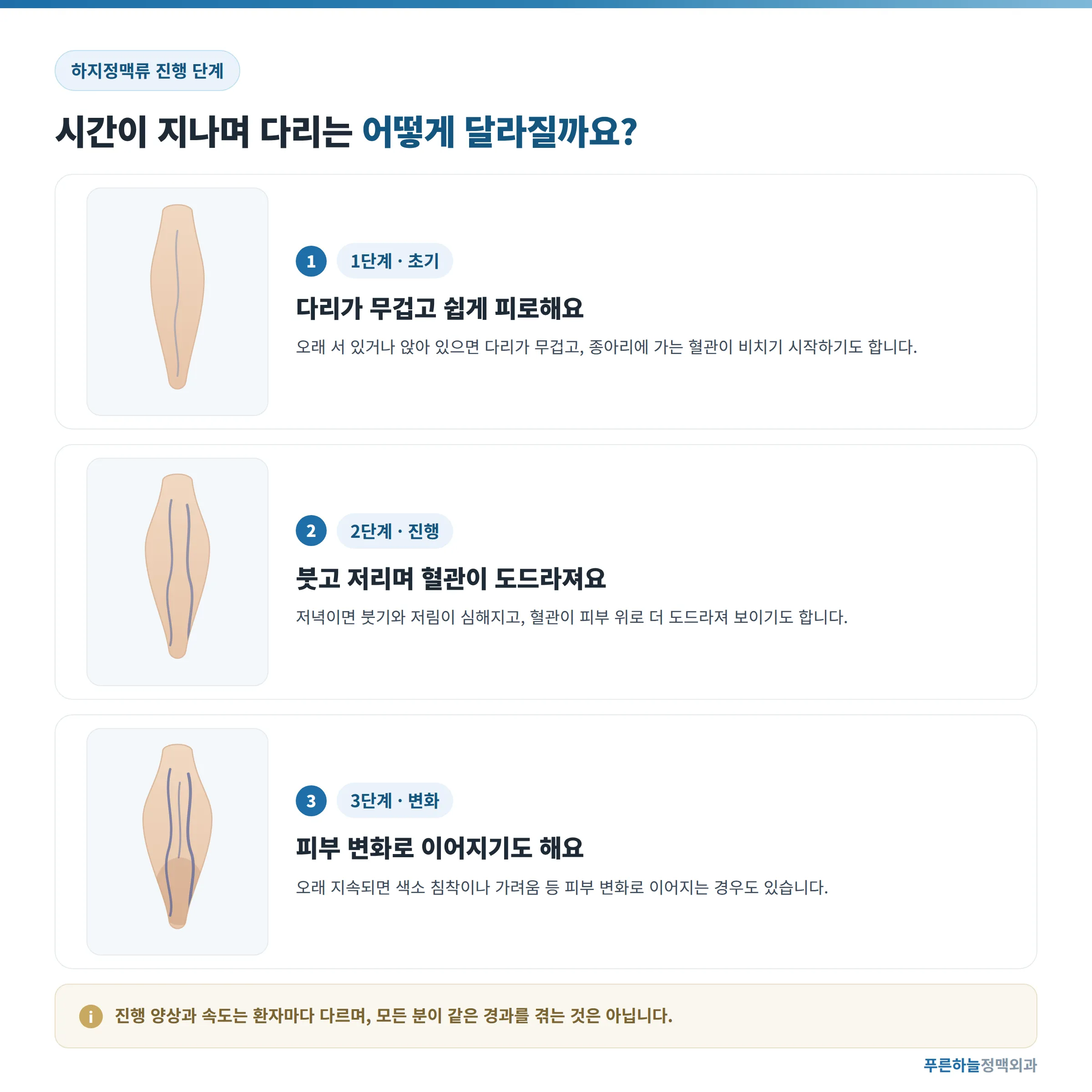 하지정맥류 진행 단계별 변화