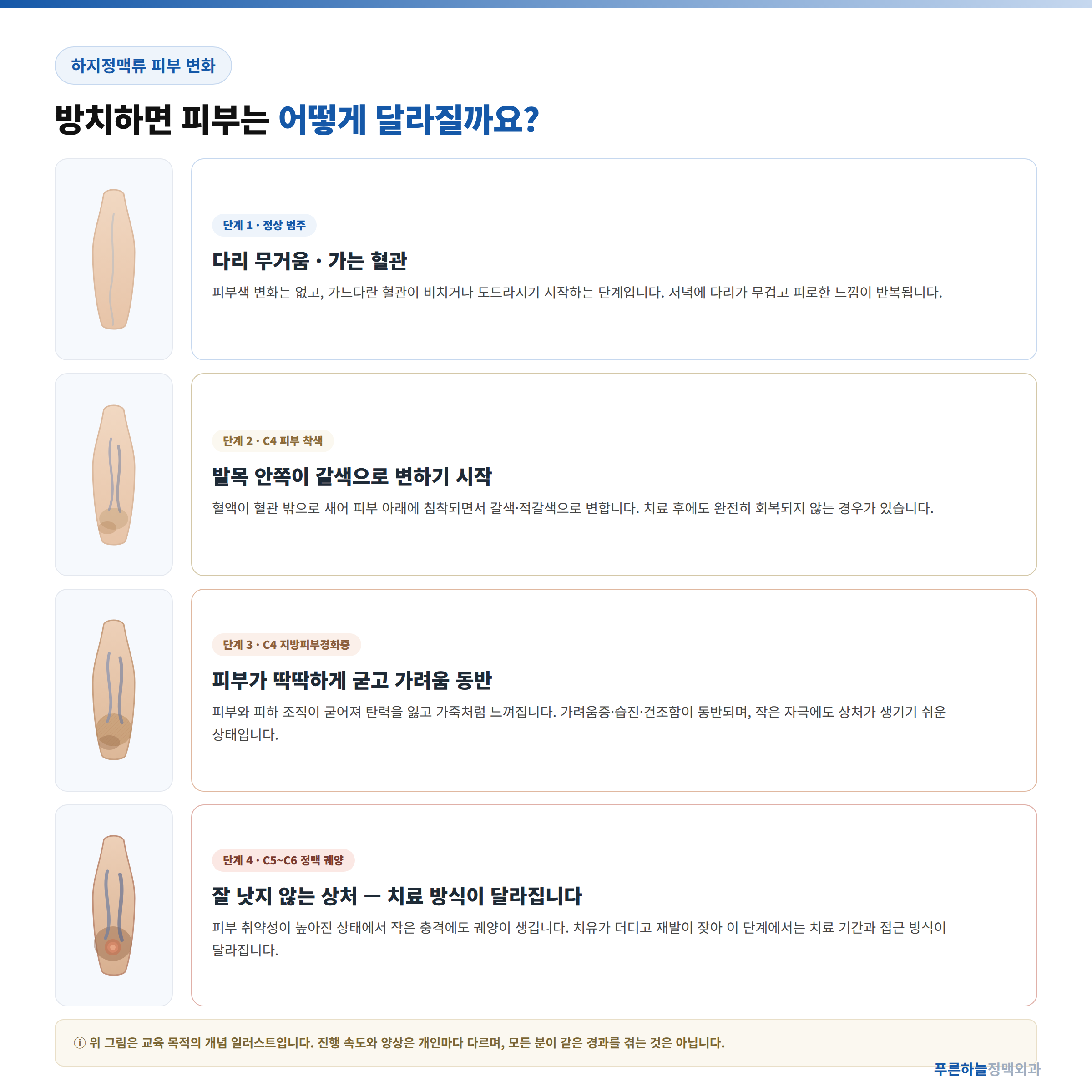 하지정맥류 피부 착색 변화