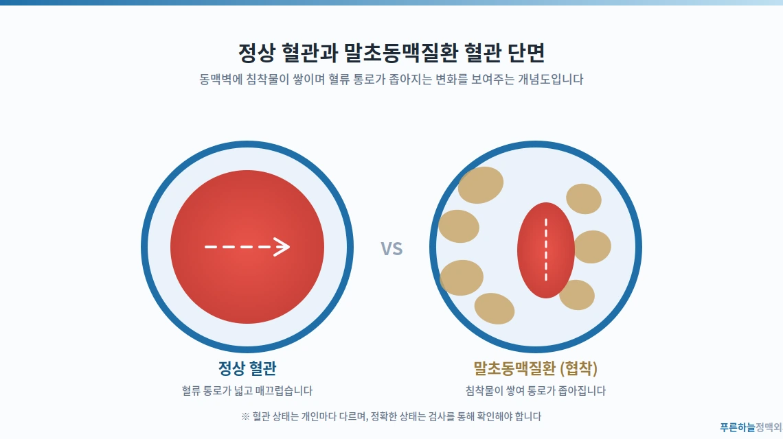 부산 말초동맥질환 다리 혈관 개념도